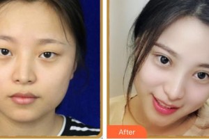 涼山愛爾眼科醫(yī)院周鵬整形價格表附眼部綜合案例展示