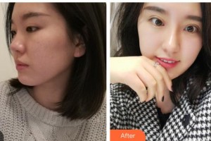 涼山愛爾眼科醫(yī)院蘇茜整形價格表附眼部綜合案例展示