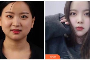 涼山愛爾眼科醫(yī)院李國(guó)良整形價(jià)格表附眼部綜合案例展示