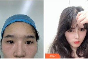 涼山愛爾眼科醫(yī)院黃應(yīng)祥整形價(jià)格表附眼部修復(fù)案例展示