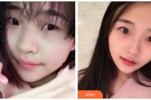 涼山州中西醫(yī)結(jié)合醫(yī)院眼科陳浩整形價(jià)格表附切開雙眼皮案例展示