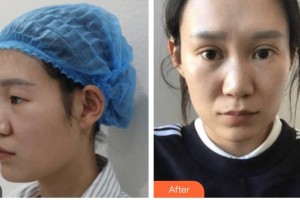 涼山愛爾眼科醫(yī)院吉江峰整形價(jià)格表附眼部綜合案例展示