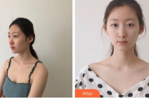 涼山彝族自治州第二人民醫(yī)院燒傷整形外科葉一整形價(jià)格表附光子嫩膚案例展示