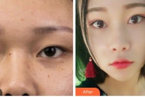 涼山州中西醫(yī)結(jié)合醫(yī)院眼科張薇整形價(jià)格表附切開雙眼皮案例展示