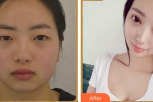 涼山州中西醫(yī)結(jié)合醫(yī)院眼科李琪整形價(jià)格表附眼部綜合案例展示