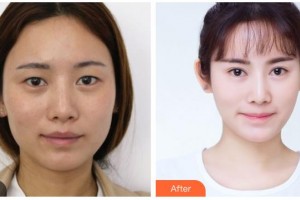 湖南省人民醫(yī)院整形激光美容中心鐘茜整形價格表附眼部綜合案例展示