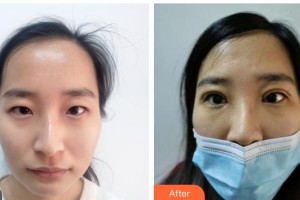 武警湖南總隊(duì)醫(yī)院整形美容中心包校偉整形價(jià)格表附眼部綜合案例展示