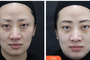 武警湖南總隊(duì)醫(yī)院整形美容中心夏紅梅整形價(jià)格表附激光去眼袋案例展示