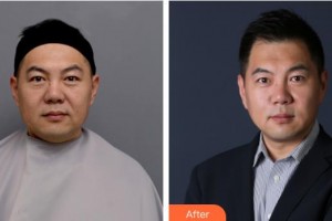 湖南省人民醫(yī)院整形激光美容中心朱軼整形價(jià)格表附埋線提升案例展示