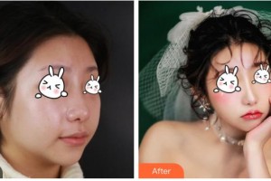 湖南省南華大學(xué)附一醫(yī)院激光美容中心謝紅炬整形價(jià)格表附激光祛斑案例展示