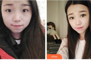 湖南省中醫(yī)藥研究院附屬醫(yī)院醫(yī)學(xué)美容中心何高洲整形價(jià)格表附切開雙眼皮案例展示