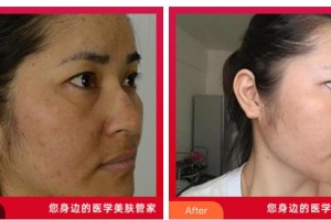 湖南省中醫(yī)藥研究院附屬醫(yī)院醫(yī)學(xué)美容中心謝會(huì)平整形價(jià)格表附微針美膚案例展示