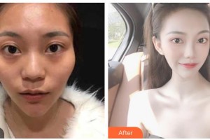 湖南省中醫(yī)藥研究院附屬醫(yī)院醫(yī)學(xué)美容中心黃寧申整形價(jià)格表附熱瑪吉案例展示