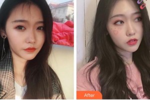 湖南省南華大學(xué)附一醫(yī)院激光美容中心陳碾 整形價(jià)格表附激光除皺案例展示