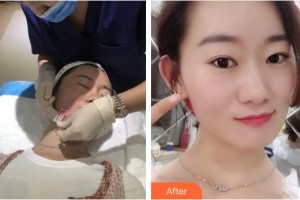 湖南中醫(yī)藥大學(xué)第一附屬醫(yī)院整形美容中心劉芳整形價(jià)格表附埋線提升案例展示