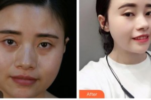 湖南省人民醫(yī)院整形激光美容中心歐陽(yáng)華偉整形價(jià)格表附埋線提升案例展示