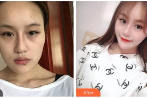 湖南省人民醫(yī)院整形激光美容中心丁衛(wèi)住院醫(yī)師整形價(jià)格表附埋線提升案例展示