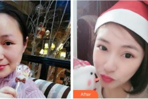 湖南省第二人民醫(yī)院整形美容中心肖調(diào)立整形價(jià)格表附埋線提升案例展示