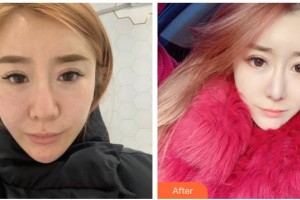 湖南師范大學(xué)第二附屬醫(yī)院燒傷整形美容中心李季整形價(jià)格表附熱瑪吉案例展示