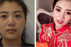 湖南師范大學(xué)第二附屬醫(yī)院燒傷整形美容中心潘飛 整形價(jià)格表附埋線提升案例展示