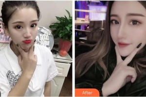 湖南美研醫(yī)療美容門(mén)診部張彬整形價(jià)格表附鼻部綜合案例展示