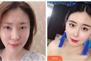 湖南美研醫(yī)療美容門診部冷美林整形價(jià)格表附鼻部綜合案例展示