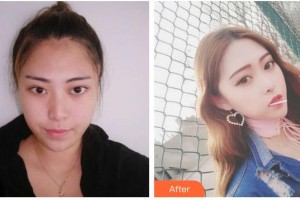 湖南愛薇爾醫(yī)療美容門診部周瑞春整形價(jià)格表附鼻部綜合案例展示