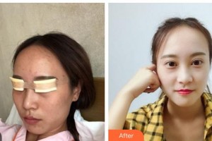 湖南博雅眼科醫(yī)院王成業(yè)整形價(jià)格表附切開雙眼皮案例展示