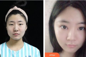 湖南博雅眼科醫(yī)院袁苑整形價(jià)格表附切開(kāi)雙眼皮案例展示