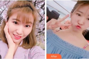 湖南博雅眼科醫(yī)院袁東坡整形價(jià)格表附切開雙眼皮案例展示