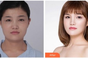 湖南博雅眼科醫(yī)院余輝整形價(jià)格表附眼部綜合案例展示