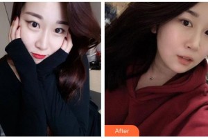 湖南博雅眼科醫(yī)院劉素平整形價(jià)格表附切開(kāi)雙眼皮案例展示