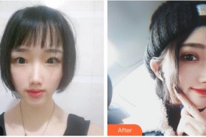 湖南博雅眼科醫(yī)院胡蓉整形價(jià)格表附切開(kāi)雙眼皮案例展示