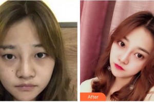 湖南博雅眼科醫(yī)院段智博整形價(jià)格表附切開(kāi)雙眼皮案例展示