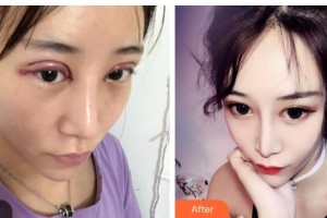 湖南省直中醫(yī)醫(yī)院眼科代敏整形價(jià)格表附切開(kāi)雙眼皮案例展示