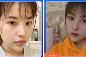 湖南醫(yī)藥學(xué)院第一附屬醫(yī)院醫(yī)療美容科張雪梅整形價(jià)格表附切開(kāi)雙眼皮案例展示