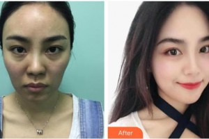 株洲嘉美醫(yī)療整形美容診所黃敏健整形價(jià)格表附埋線提升案例展示