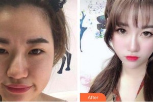 株洲中雅醫(yī)療美容門(mén)診部文學(xué)海整形價(jià)格表附埋線提升案例展示