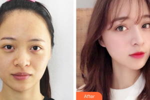 中國科學院大學深圳醫(yī)院醫(yī)療美容科梁大寧整形價格表附超激光美膚激光祛斑案例展示