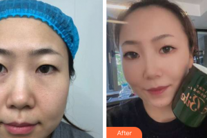 深圳美加美醫(yī)療美容門診部邱斌整形價(jià)格表附眼部手術(shù)案例展示