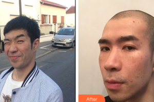 深圳美加美醫(yī)療美容門診部張顯平整形價(jià)格表附切開雙眼皮案例展示