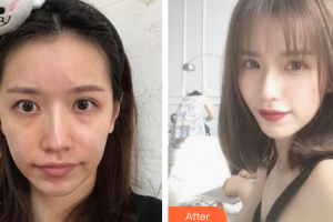 深圳美加美醫(yī)療美容門診部李月慶整形價(jià)格表附埋線提升案例展示