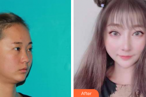 深圳吉美瑞麗斯醫(yī)療美容門診部魯璐整形價(jià)格表附肋軟骨隆鼻案例展示