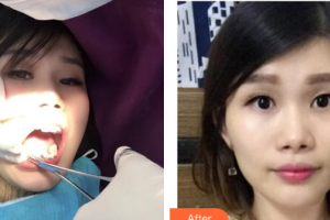 深圳博愛曙光醫(yī)院鐘春根整形價(jià)格表附金屬矯正案例展示