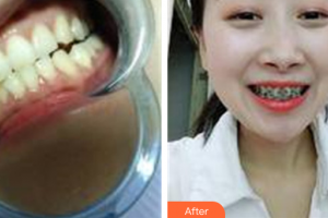 深圳博愛曙光醫(yī)院劉佺整形價(jià)格表附牙齒矯正案例展示