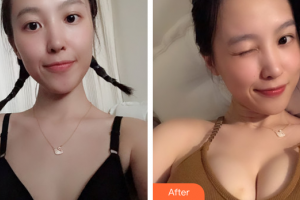 珠海微創(chuàng)外科醫(yī)院李長(zhǎng)江整形價(jià)格表附自體脂肪隆胸案例展示