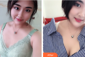 珠海陸達(dá)美容外科醫(yī)院陳越文整形價(jià)格表附自體脂肪隆胸案例展示