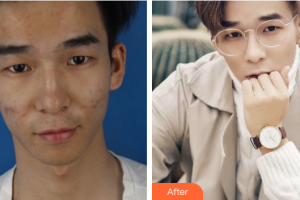 珠海陸達(dá)美容外科醫(yī)院曾超整形價(jià)格表附微針祛痘煥膚案例展示