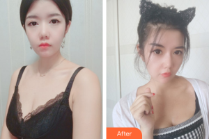 珠海陸達(dá)美容外科醫(yī)院侯大慶整形價(jià)格表附自體脂肪隆胸案例展示