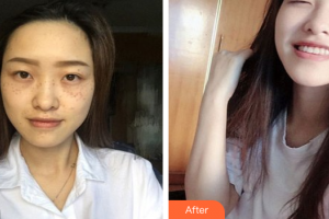 珠海陸達(dá)美容外科醫(yī)院王愛平整形價(jià)格表附激光美膚祛斑案例展示